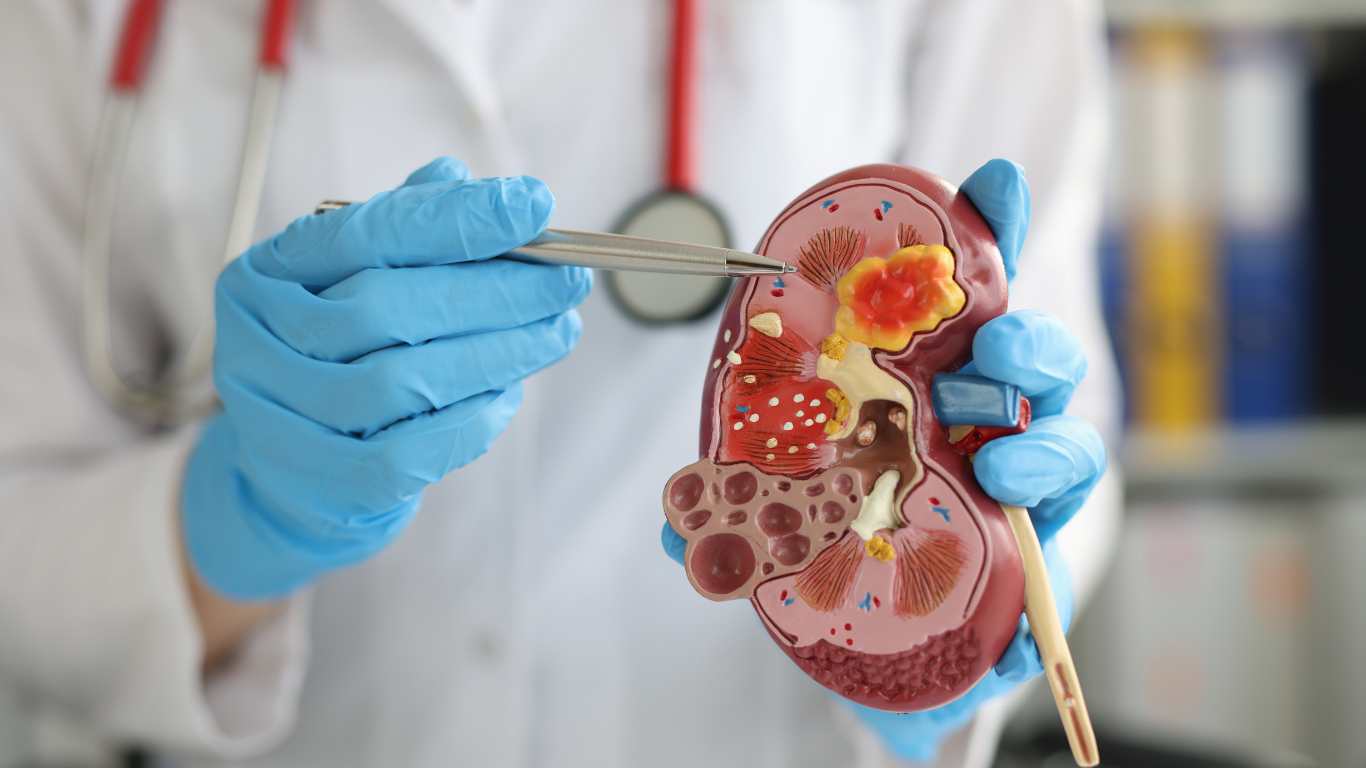 Glomerulonephritis: When the Kidney Filters Become Inflamed